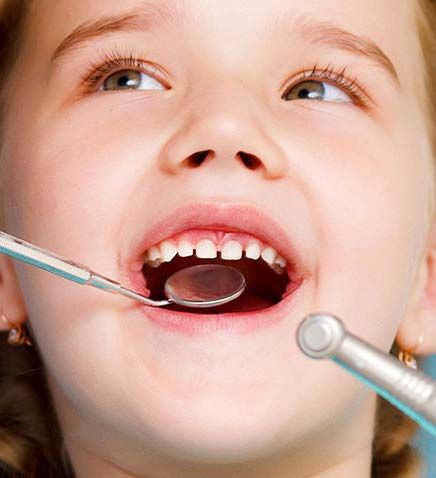 آیا دندان شیری نیاز به عصب‌کشی دارد؟